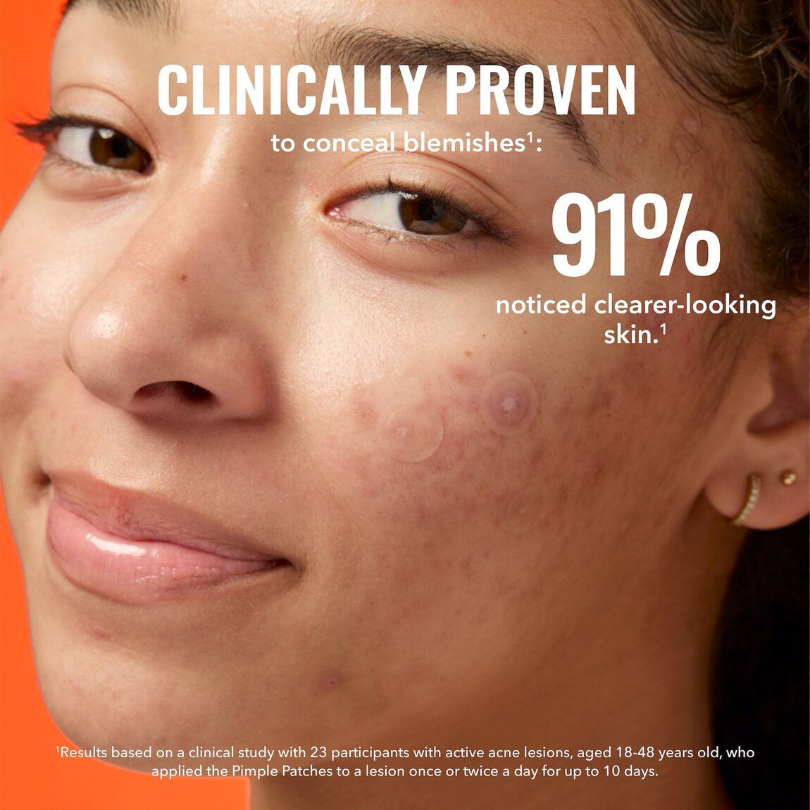 pimple-patches-v7 zb_p.jpg