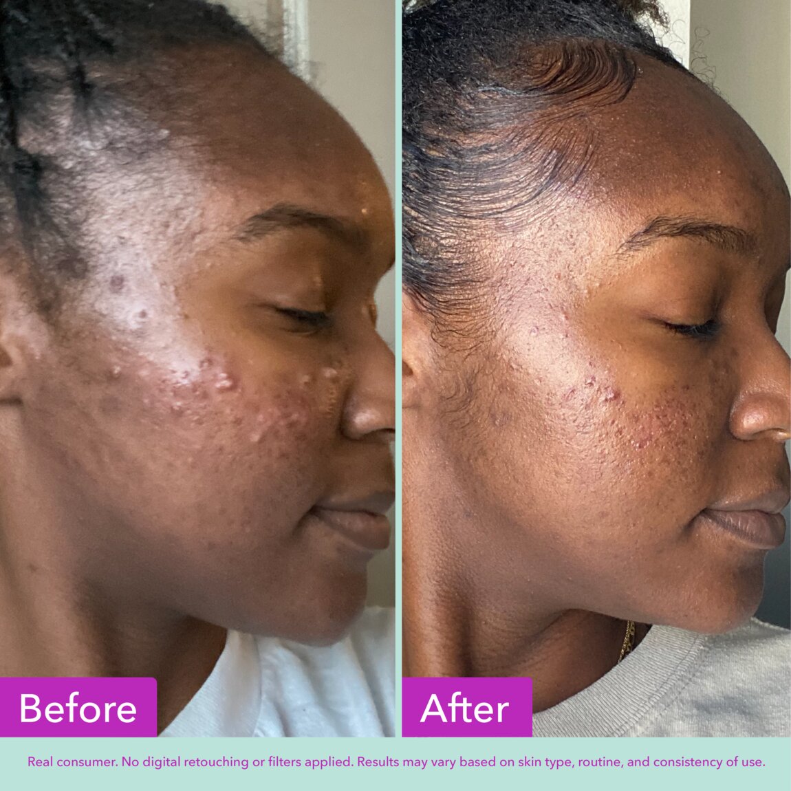 acne-foaming-cleanser-j4 zb_p.jpg